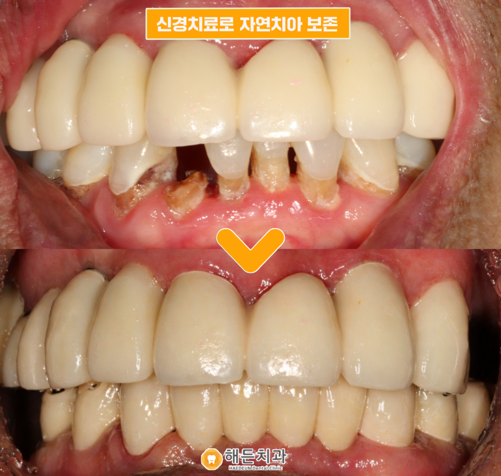 아산시충치치료